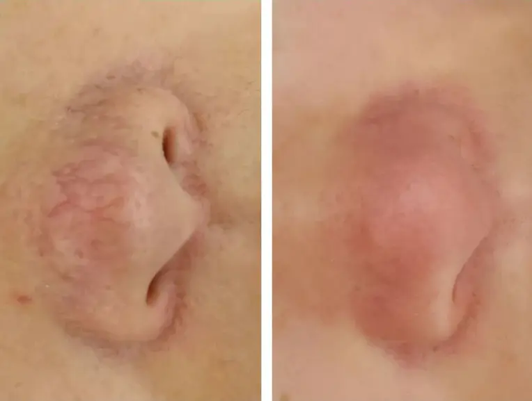 Laser Vein Removal