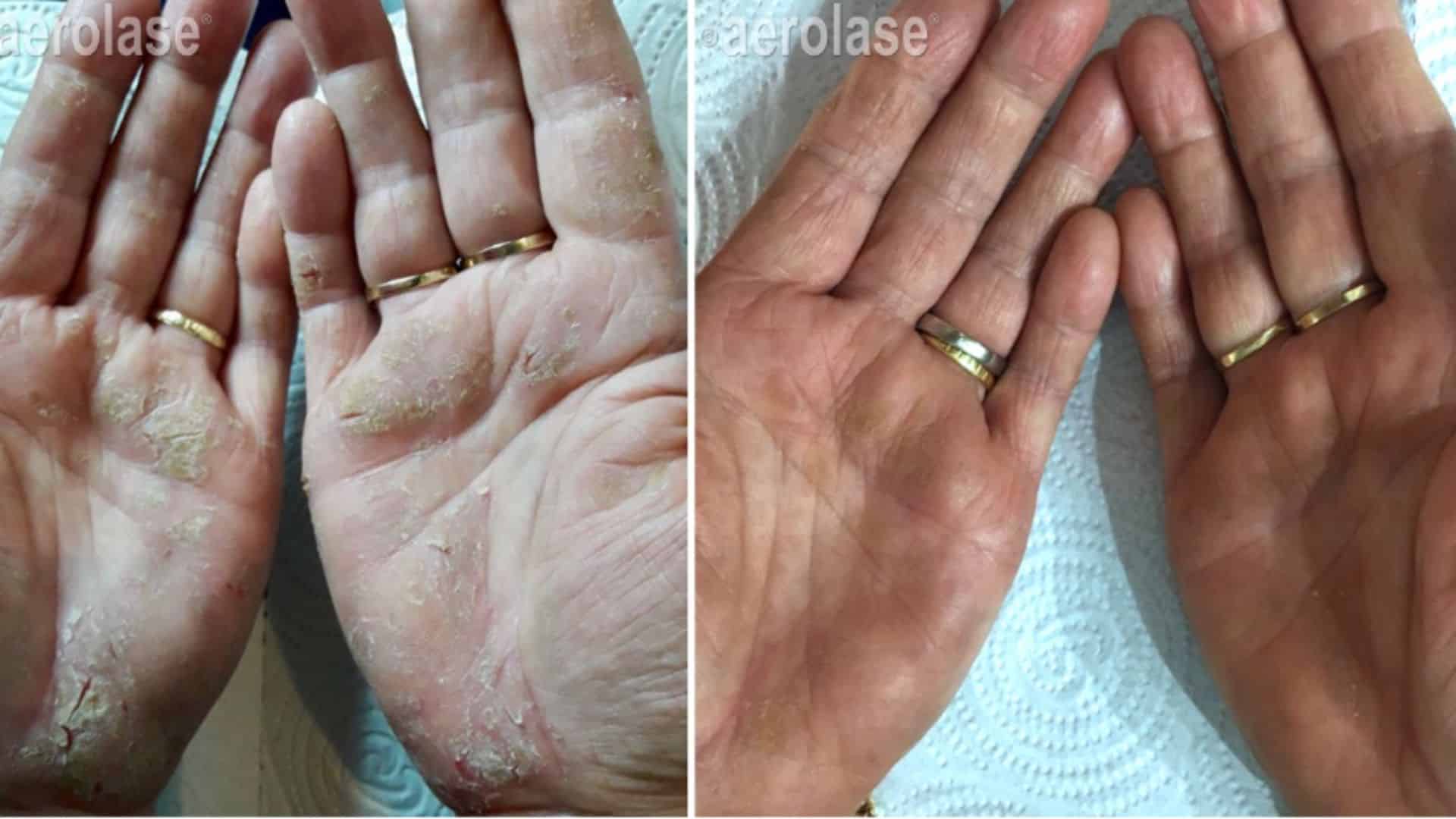 Before and after psoriasis treatment