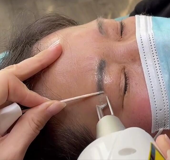 What should we pay attention to before and after laser eyebrow tattoo removal?