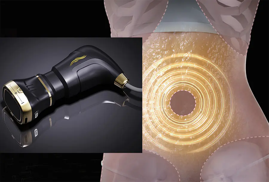 Hifu Body Contouring