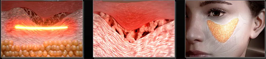 22d Hifu Face Body Abdomen