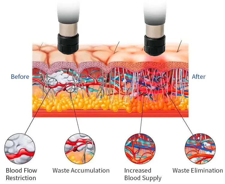 Shockwave Therapy for Ed