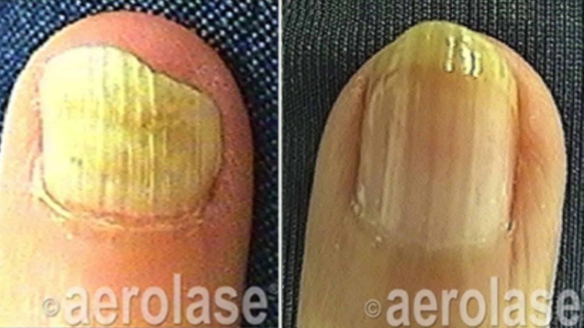 before and after nail treatment