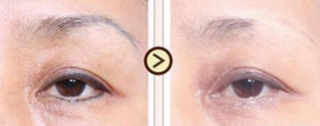 laser microblading removal