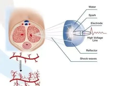 Ed Treatment Shockwave