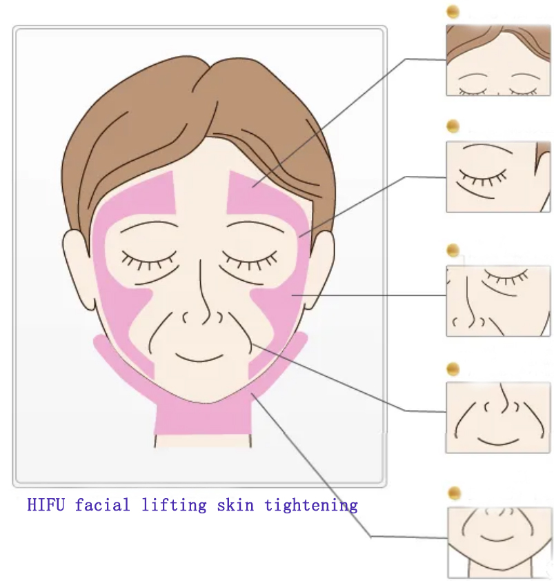 How To Draw Treatment Lines Before HIFU Facial Lifting Treatment To Avoid Skin Damage?
