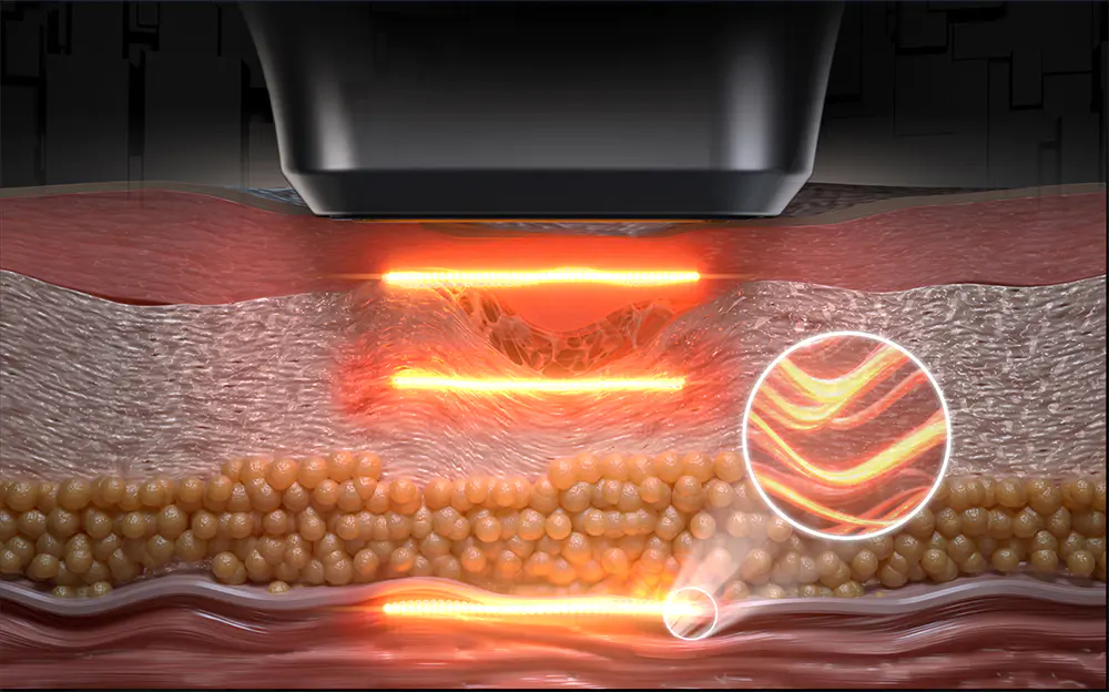 12D Hifu Machine