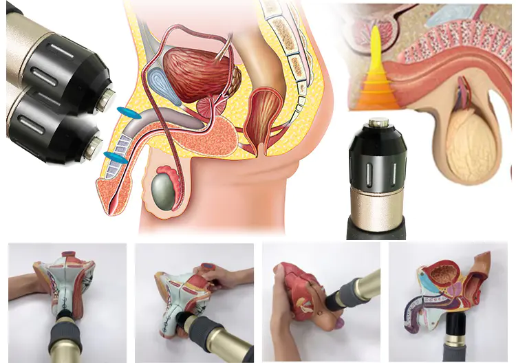 Extracorporeal Shockwave Therapy for Ed