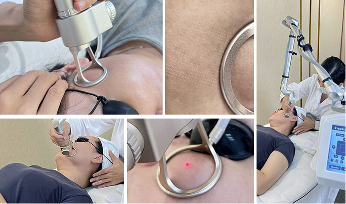 Why Do People Choose CO2 Fractional Laser?