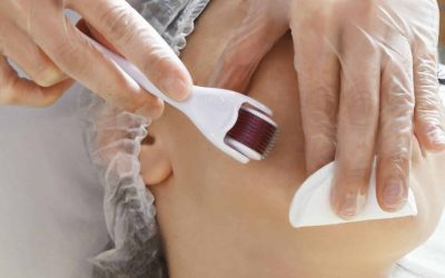 Img Of Microneedling