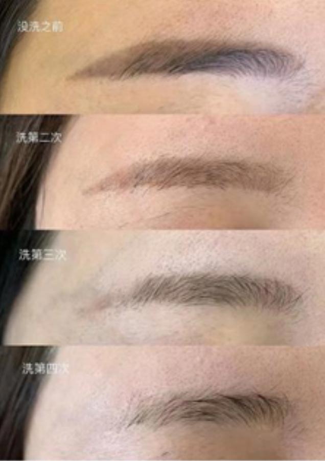 laser microblading removal
