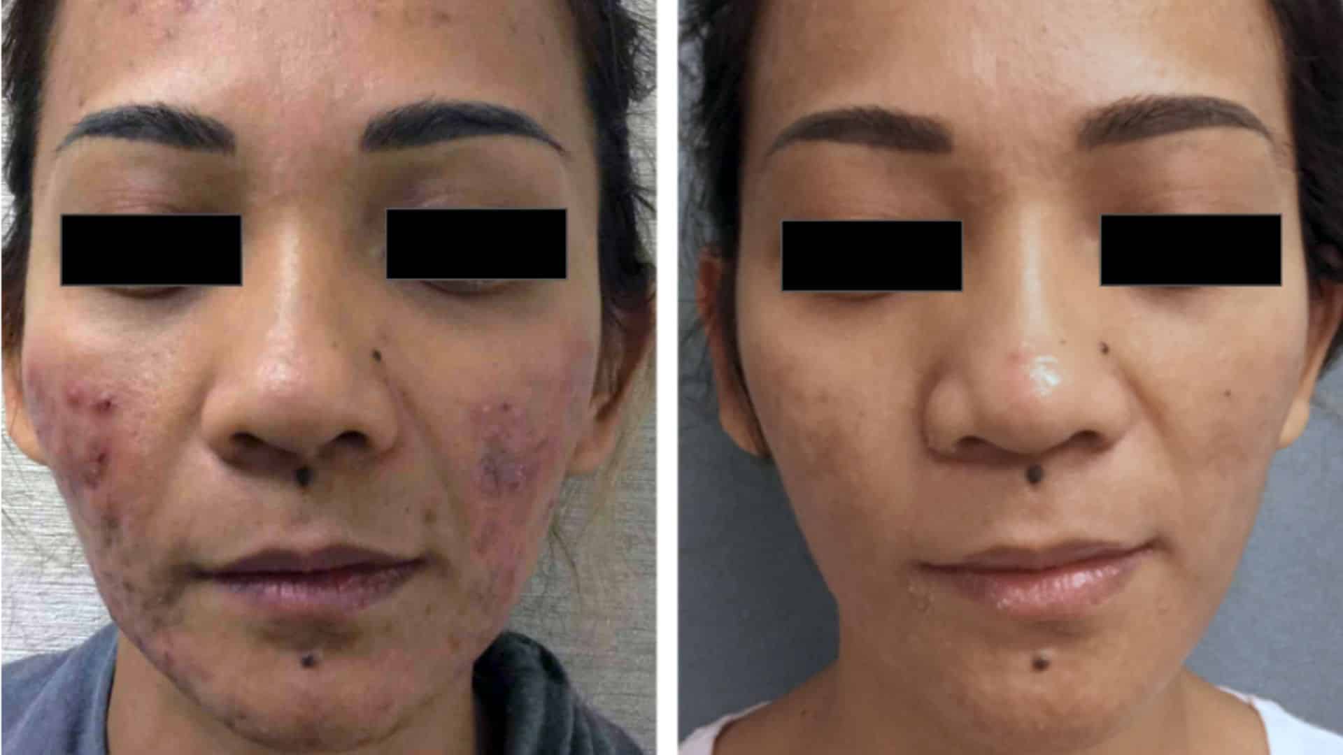 Before and after acne treatment