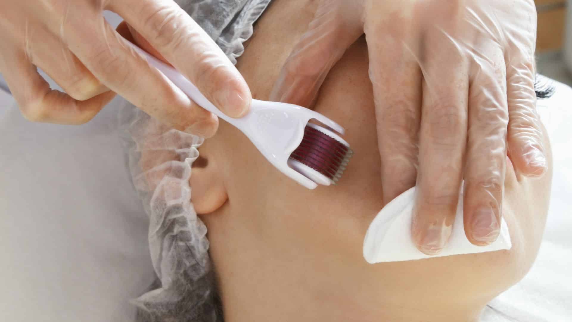 img of Microneedling