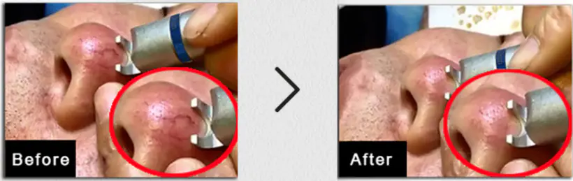 Thread Vein Removal