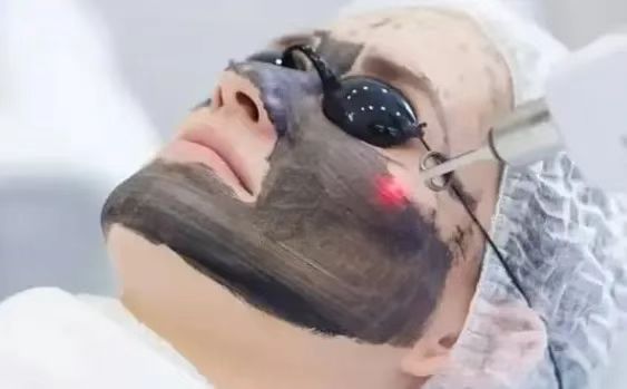 carbon peeling