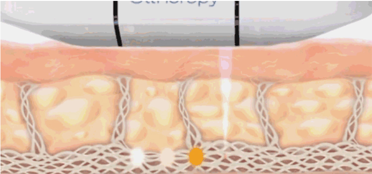 HIFU treatment