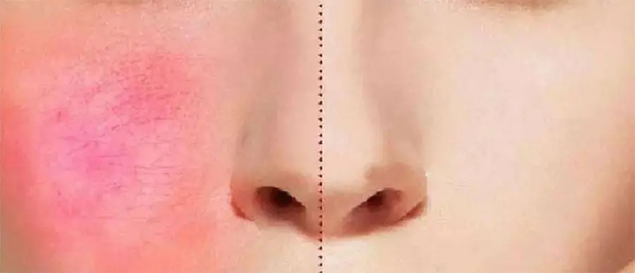 Laser Spider Vein Removal